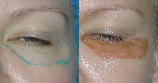 Laser blepharoplasty. Reviews of the operated lower, upper eyelids, how they do it. Prices