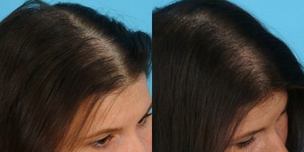 Mesotherapy of the scalp of the scalp. What is it, effect, price. How to do it at home