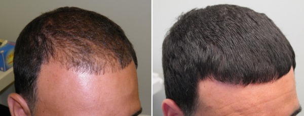 Mesotherapy of the scalp of the scalp. What is it, effect, price. How to do it at home