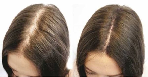 Mesotherapy of the scalp of the scalp. What is it, effect, price. How to do it at home