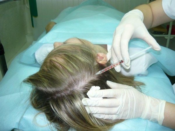 Mesotherapy of the scalp of the scalp. What is it, effect, price. How to do it at home