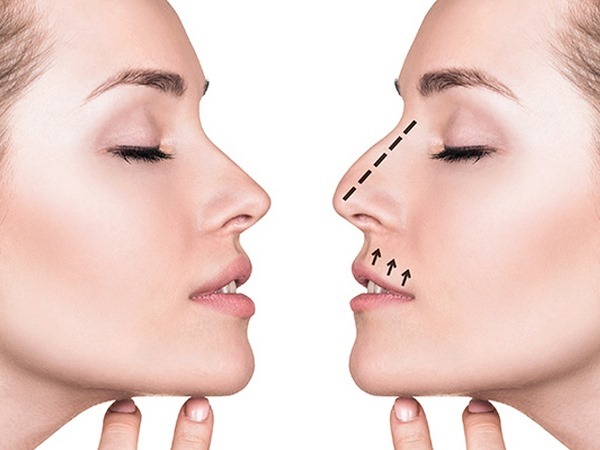 Rhinoplasty in Moscow. Prices and reviews for clinics in the capital