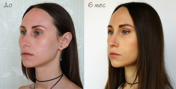 Rhinoplasty in Moscow. Prices and reviews for clinics in the capital