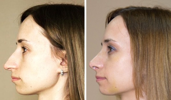 Rhinoplasty in Moscow. Prices and reviews for clinics in the capital