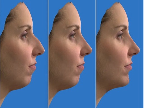 Rhinoplasty in Moscow. Prices and reviews for clinics in the capital