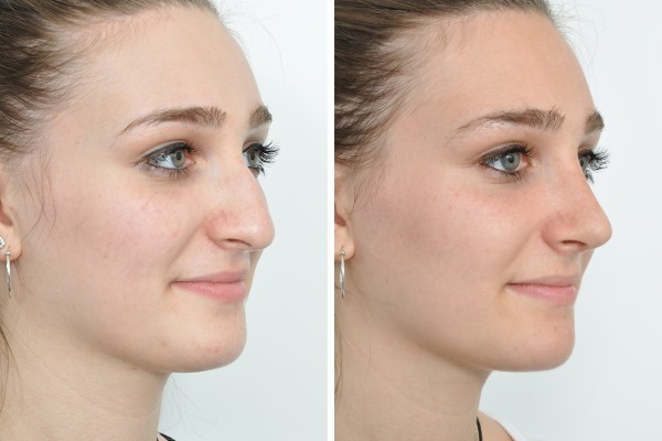 Rhinoplasty in Moscow. Prices and reviews for clinics in the capital