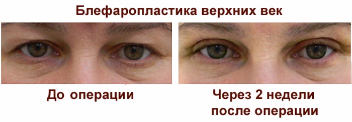 Laser blepharoplasty. Reviews of the operated lower, upper eyelids, how they do it. Prices