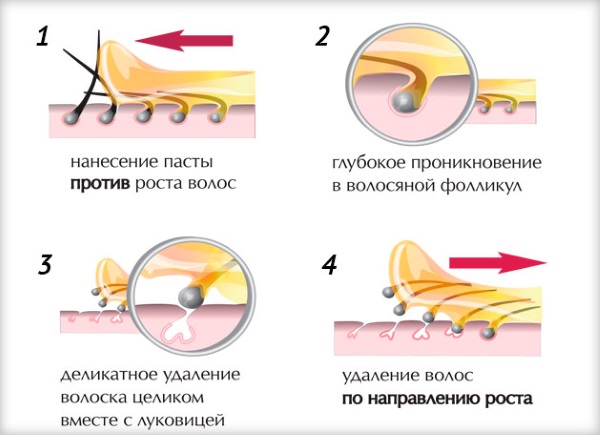 Photoepilation or laser hair removal, shugaring, electrolysis. Which is better, pros and cons