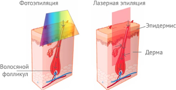 Photoepilation or laser hair removal, shugaring, electrolysis. Which is better, pros and cons