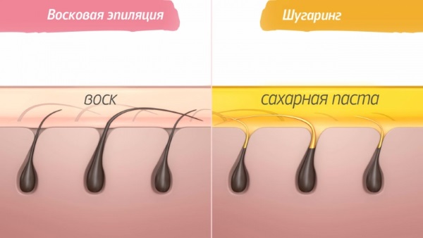 Photoepilation or laser hair removal, shugaring, electrolysis. Which is better, pros and cons