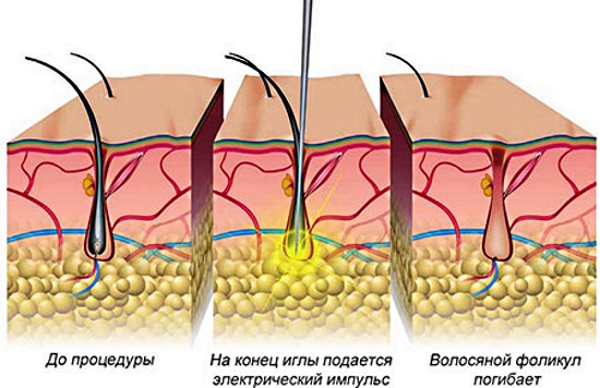 Photoepilation or laser hair removal, shugaring, electrolysis. Which is better, pros and cons