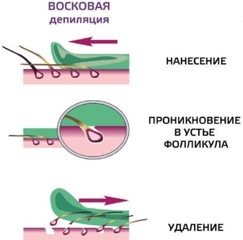 Photoepilation or laser hair removal, shugaring, electrolysis. Which is better, pros and cons