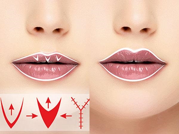 How to enlarge lips with hyaluronic acid, botox, silicone, lipofilling, cheiloplasty. Photos, prices, reviews