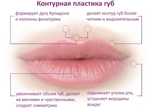 How to enlarge lips with hyaluronic acid, botox, silicone, lipofilling, cheiloplasty. Photos, prices, reviews