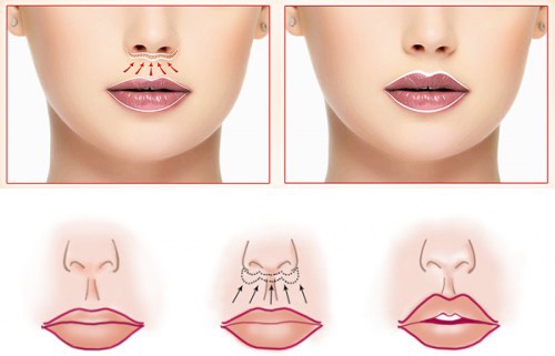 How to enlarge lips with hyaluronic acid, botox, silicone, lipofilling, cheiloplasty. Photos, prices, reviews