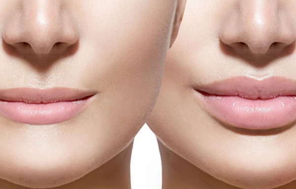 How to enlarge lips with hyaluronic acid, botox, silicone, lipofilling, cheiloplasty. Photos, prices, reviews