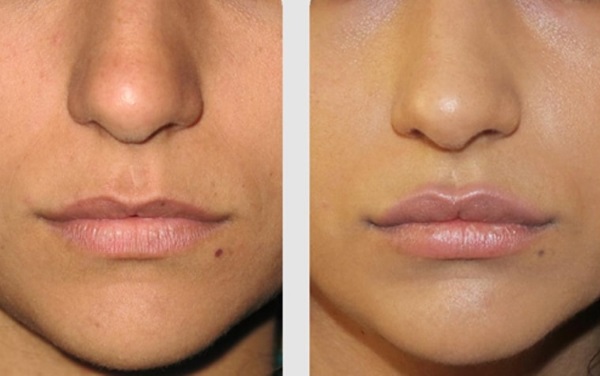 How to enlarge lips with hyaluronic acid, botox, silicone, lipofilling, cheiloplasty. Photos, prices, reviews