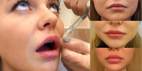 How to enlarge lips with hyaluronic acid, botox, silicone, lipofilling, cheiloplasty. Photos, prices, reviews