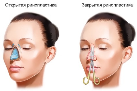 Rhinoplasty in Moscow. Prices and reviews for clinics in the capital