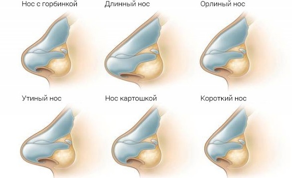 Rinoseptoplasty. What is it, open, closed, laser surgery, rehabilitation period, prices