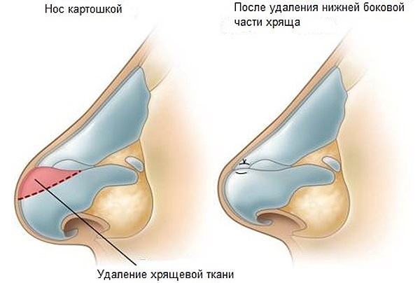 Rinoseptoplasty. What is it, open, closed, laser surgery, rehabilitation period, prices