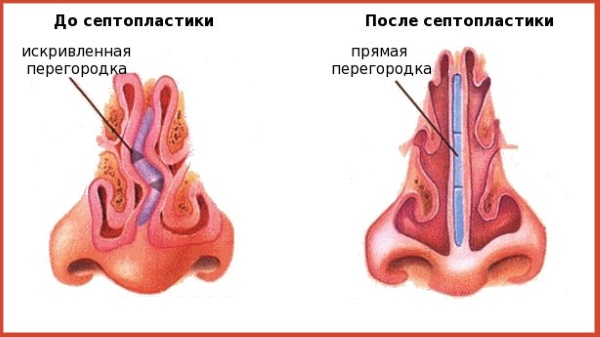 Rinoseptoplasty.What is it, open, closed, laser surgery, rehabilitation period, prices