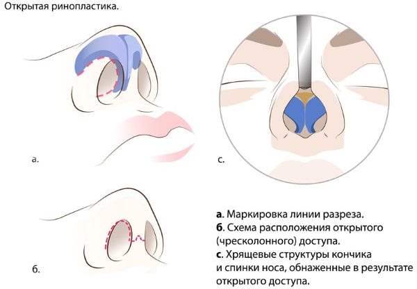 Rinoseptoplasty. What is it, open, closed, laser surgery, rehabilitation period, prices