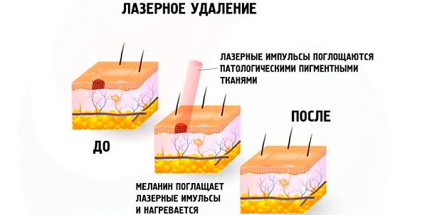 Removal of age spots on the face with a laser, photo flash, liquid nitrogen, folk remedies