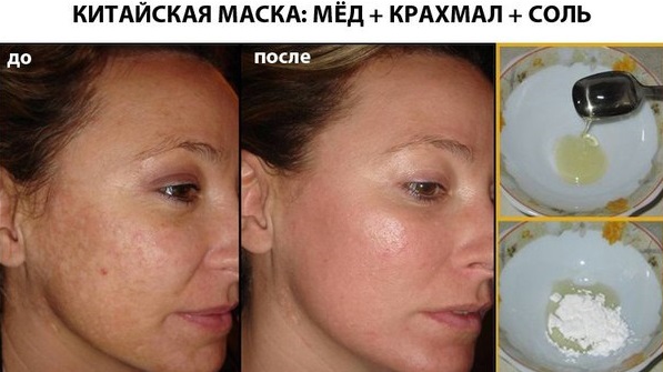 Removal of age spots on the face with a laser, photo flash, liquid nitrogen, folk remedies