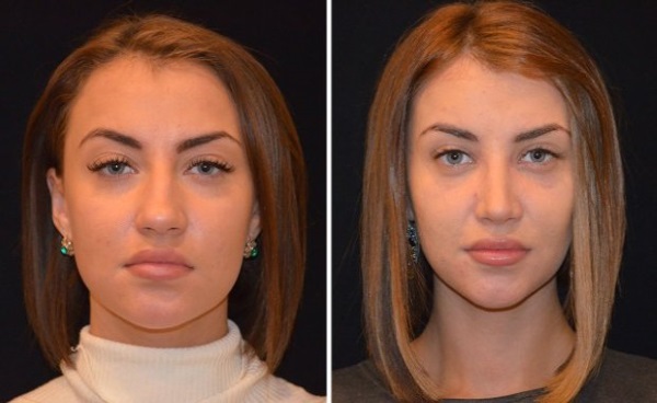 Victoria Bernikova before and after plastic surgery. Shape options