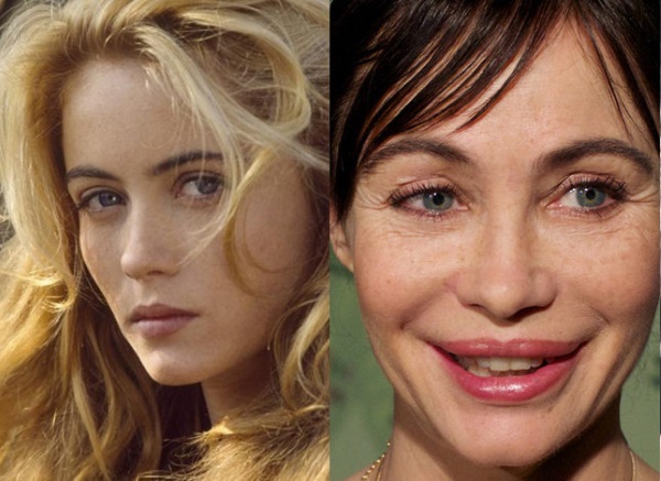 Emmanuelle Bear. Photos before and after plastic surgery, how the French actress has changed