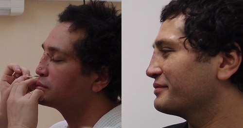 Rustam Solntsev before and after plastic surgery. Photo, what it looks like now