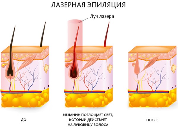 Epilation with alexandrite laser. What is it, the pros and cons of the procedure, the cost