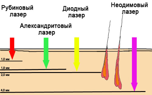 Epilation with alexandrite laser. What is it, the pros and cons of the procedure, the cost