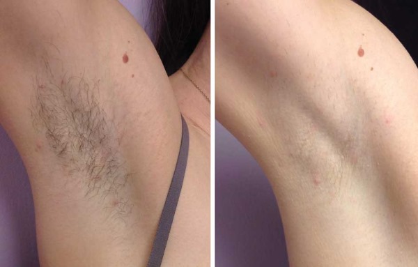 Epilation with alexandrite laser. What is it, the pros and cons of the procedure, the cost