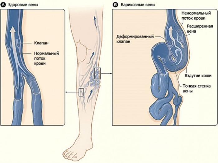 Epilation with alexandrite laser. What is it, the pros and cons of the procedure, the cost