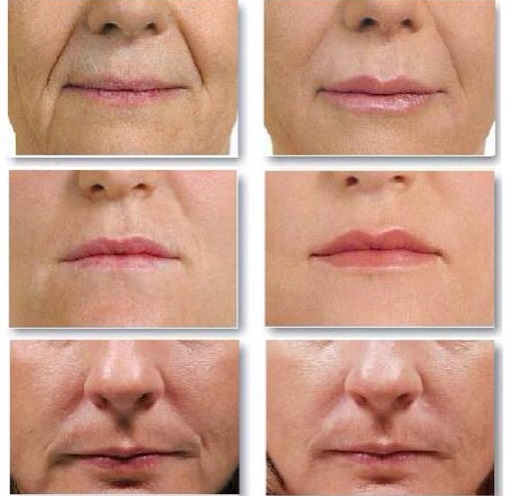 Injection facial contouring. What it is. Before and after photos, preparations, price