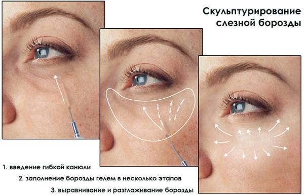 Injection facial contouring. What it is. Before and after photos, preparations, price