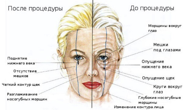 Injection facial contouring. What it is. Before and after photos, preparations, price