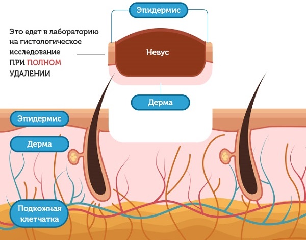 How to get rid of moles on the face with a beautician, methods at home