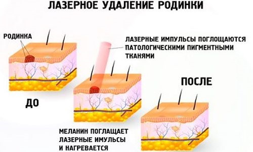 How to get rid of moles on the face with a beautician, methods at home