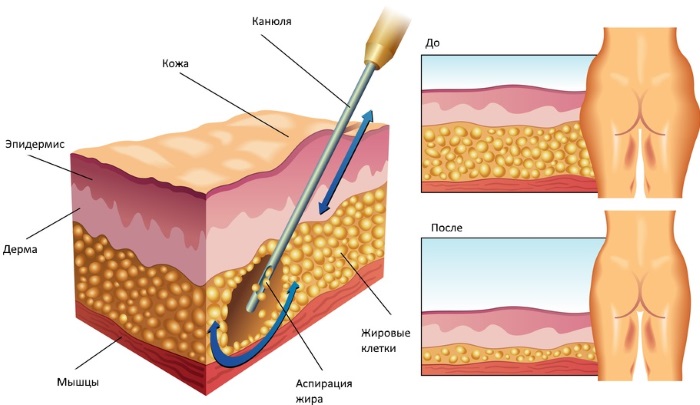 How to remove a big belly in women and men. Causes and remedies