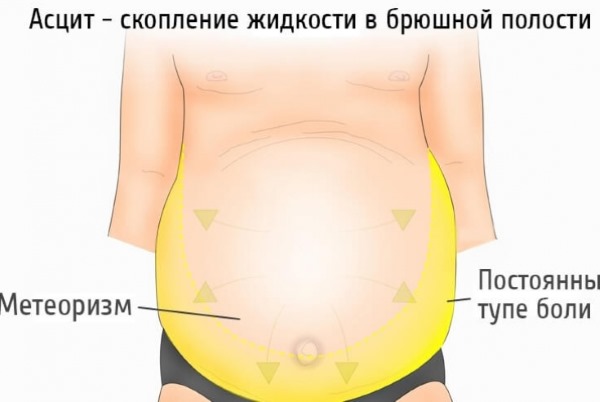 How to remove a big belly in women and men. Causes and remedies