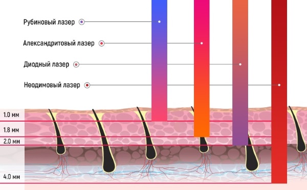 Laser hair removal. Is it harmful to health, doctors' reviews, contraindications and consequences. How often can you do