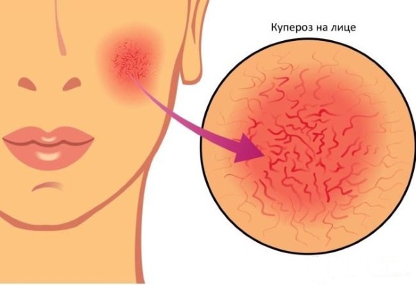 Laser removal of blood vessels on the face with a neodymium laser, flash, elos. before and after photos, reviews