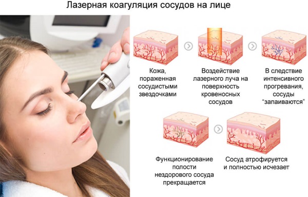 Laser removal of blood vessels on the face with a neodymium laser, flash, elos. before and after photos, reviews