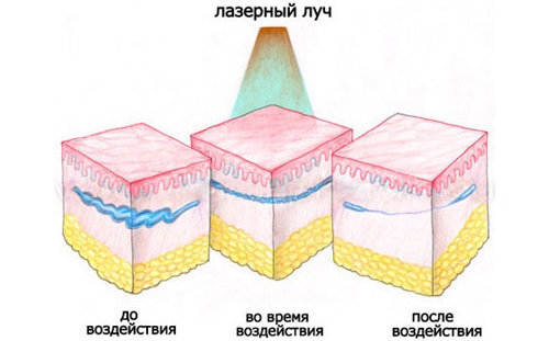 Laser removal of blood vessels on the face with a neodymium laser, flash, elos. before and after photos, reviews