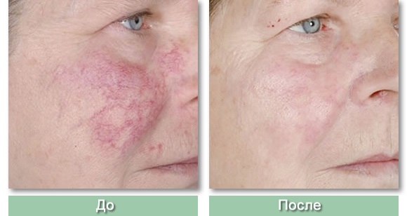 Laser removal of blood vessels on the face with a neodymium laser, flash, elos. before and after photos, reviews