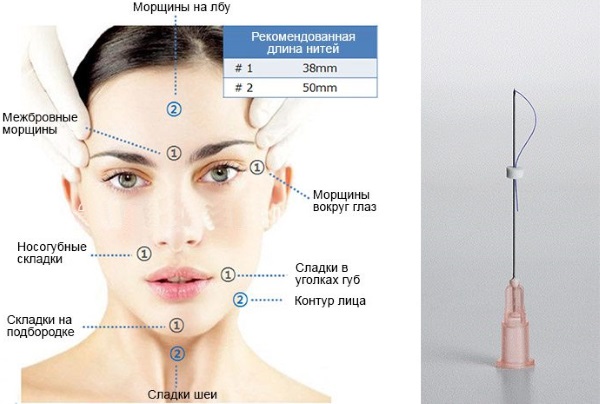 Cog threads for facelift. Price, reviews, before and after photos, rehabilitation