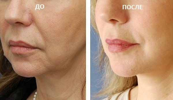 Cog threads for facelift. Price, reviews, before and after photos, rehabilitation